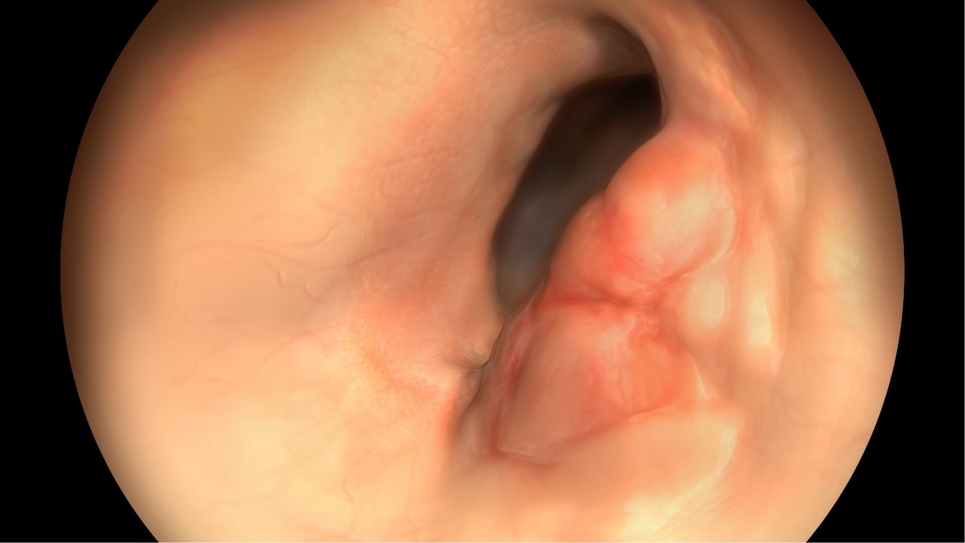 EAR CANAL SWELLING