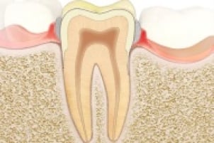 Zahnfleischentzündung (Gingivitis)