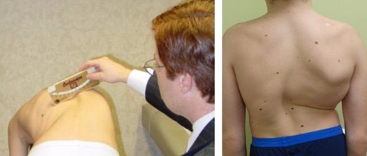 Pediatric Scoliosis Introduction