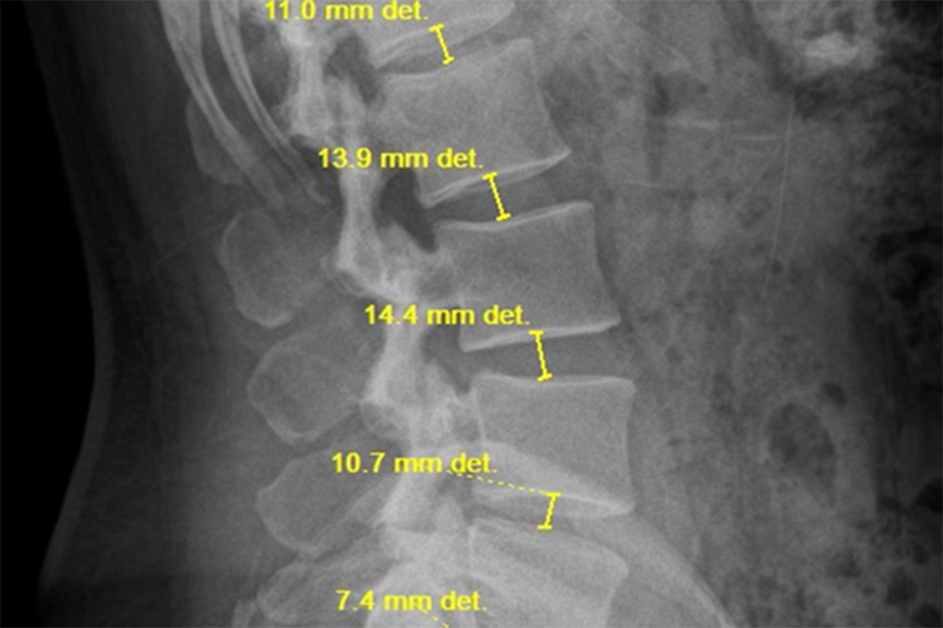 Dorso Carezza Posture, TLSO: T2-S1, Spine