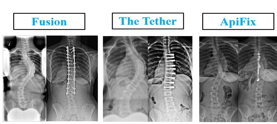 Pediatric Scoliosis Treatment