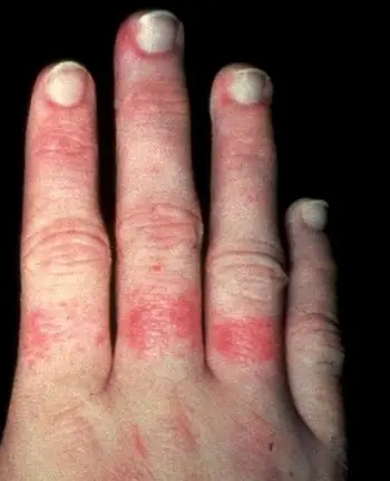 40-Year-Old Male with Recurrent Erythematous Rash - The Doctor's