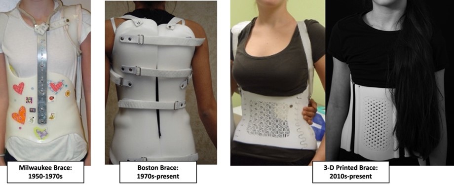 Milwaukee Brace vs New Scoliosis Braces: Which Is Better?