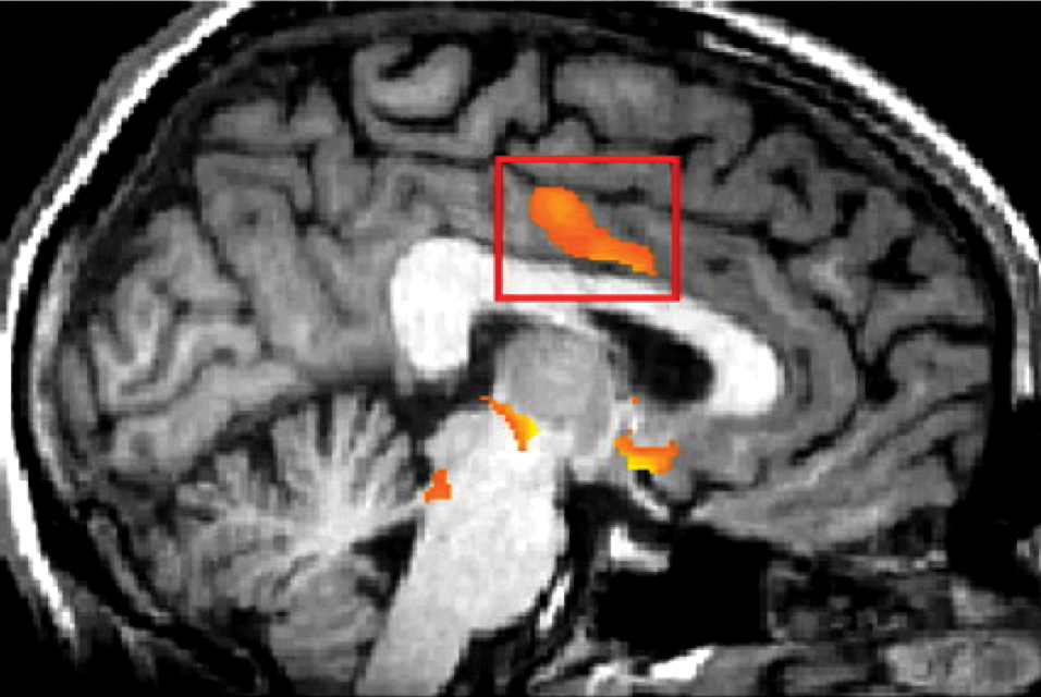 Update: Clinical Challenges in the Diagnosis And Management of Fibromyalgia