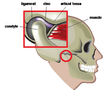 Early Treatment of TMD May Prevent Chronic Pain and Disability