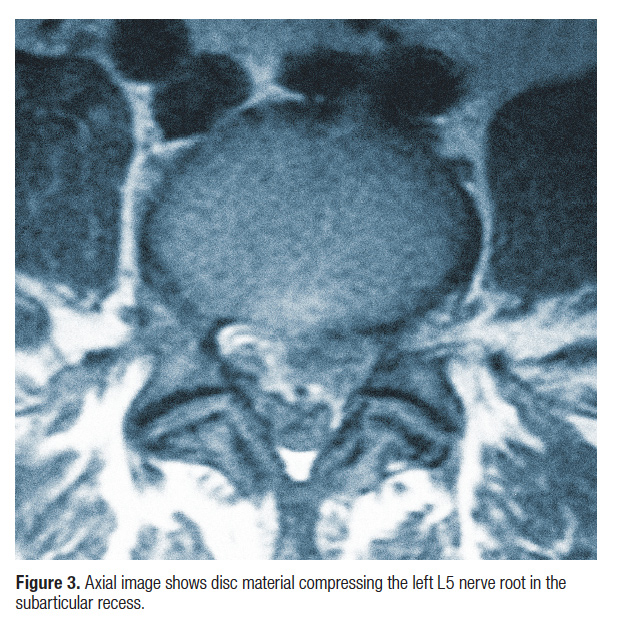 Spontaneous Low Back Pain, Radiculopathy, And Weakness in a 28-Year-Old