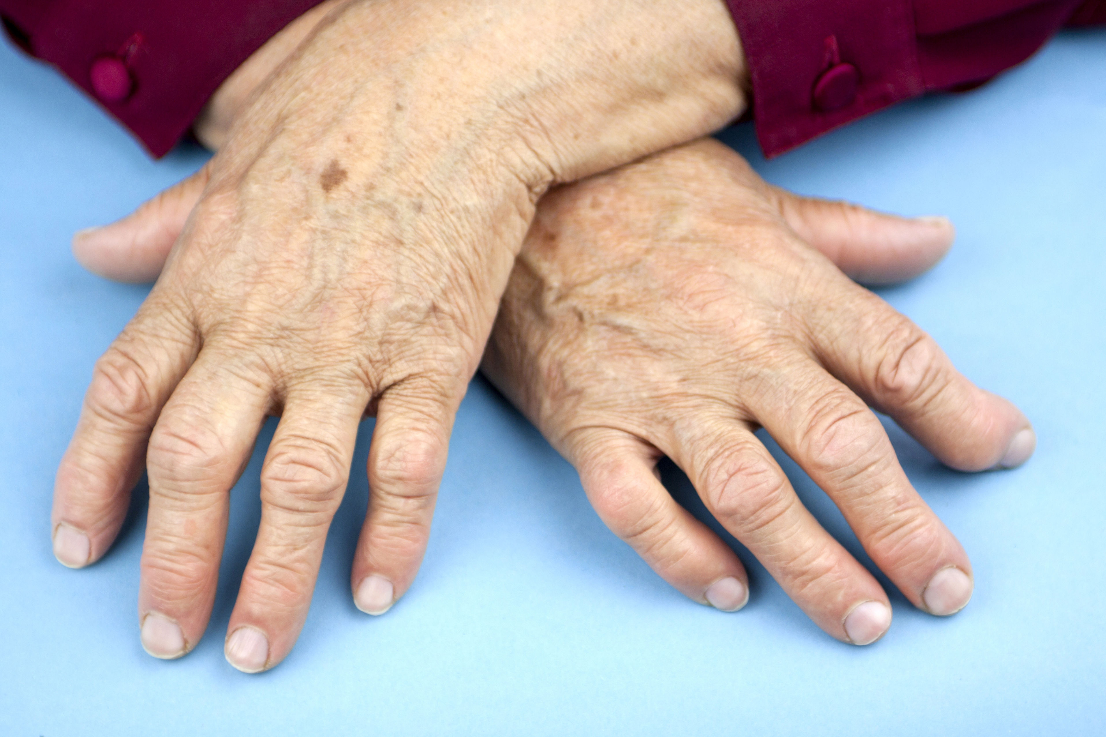 Can you mix DMARDs with opioids for rheumatoid arthritis?