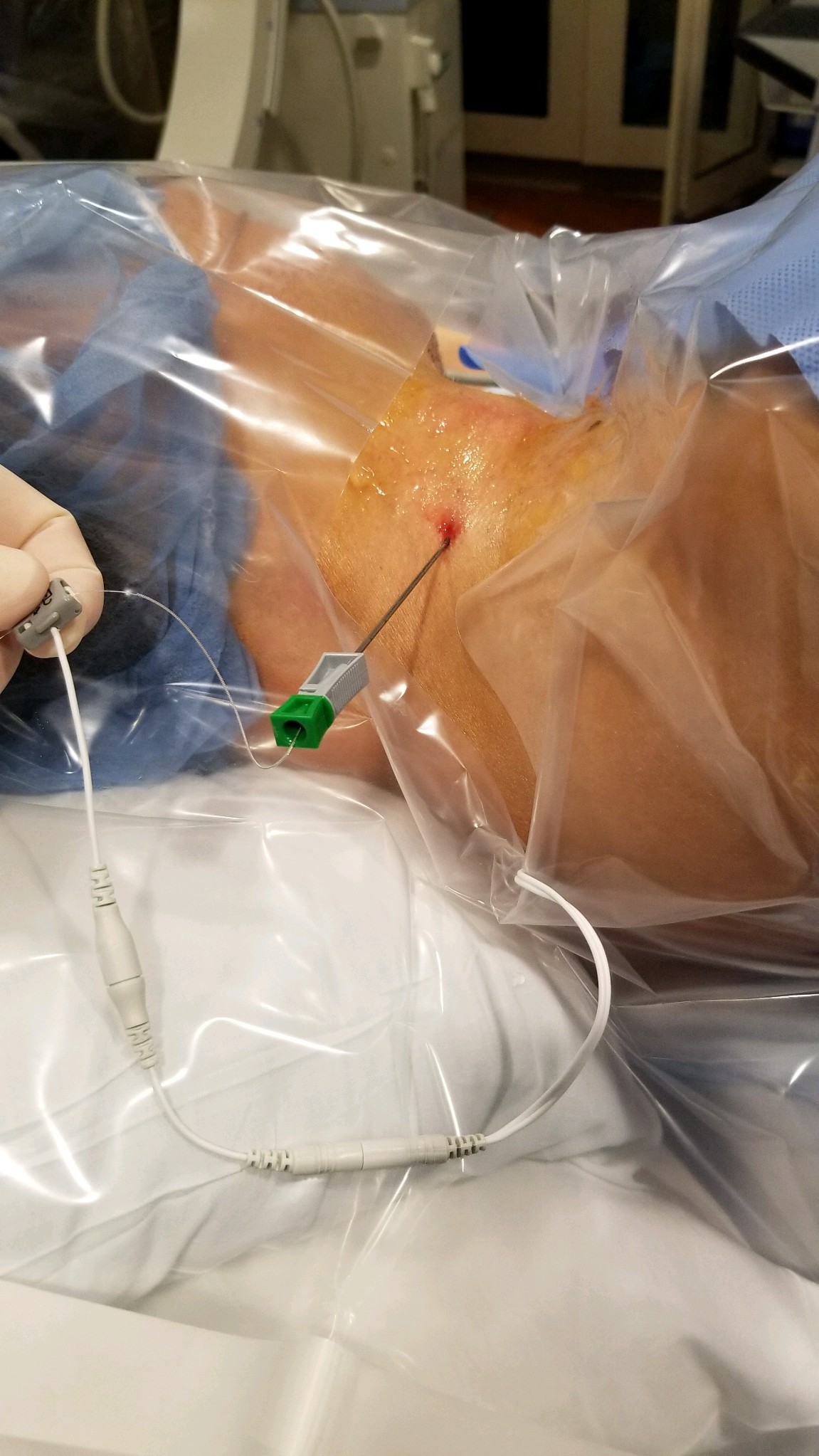 Interscalene Peripheral Nerve Stimulation for Post-Operative Chronic  Shoulder Pain