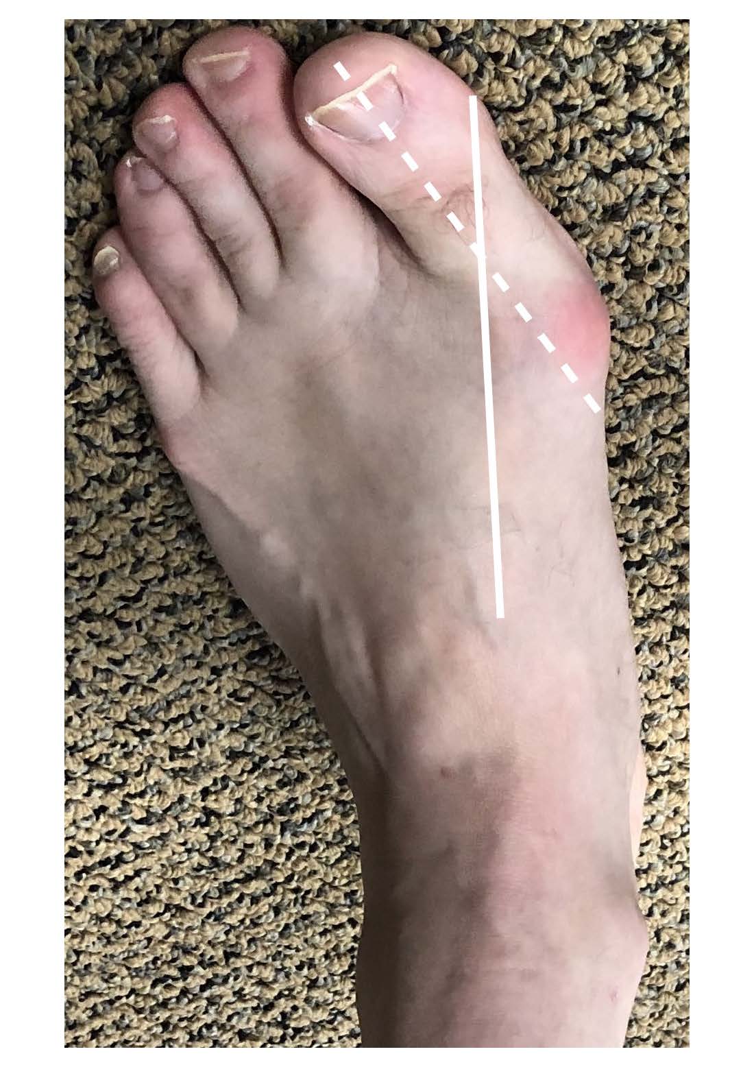 Morton's Toe and Chronic Pain