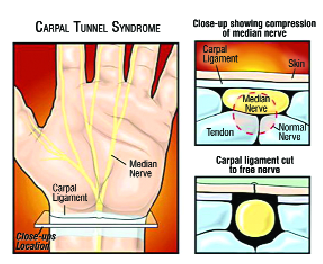 Non-surgical Decompression Treatment for Carpal Tunnel Syndrome
