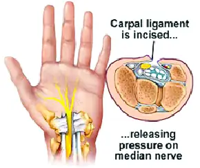 Non-Surgical Treatments for Carpal Tunnel Syndrome
