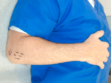 Hackett-Hemwall Dextrose Prolotherapy for Unresolved Elbow Pain