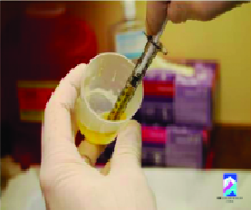 Platelet Rich Plasma for Hamstring Tears