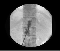 Avoiding Complications From Interventional Spine Techniques
