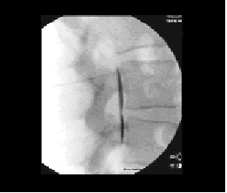 Avoiding Complications From Interventional Spine Techniques
