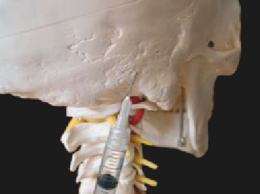 Occipital Nerve Block for Cervicogenic Headaches