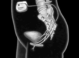 Pelvic Floor Dysfunction A Treatment Update