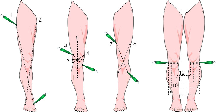 placement of Tens unit for kne and neuropathy
