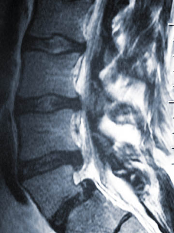 Spontaneous Low Back Pain, Radiculopathy, And Weakness in a 28-Year-Old
