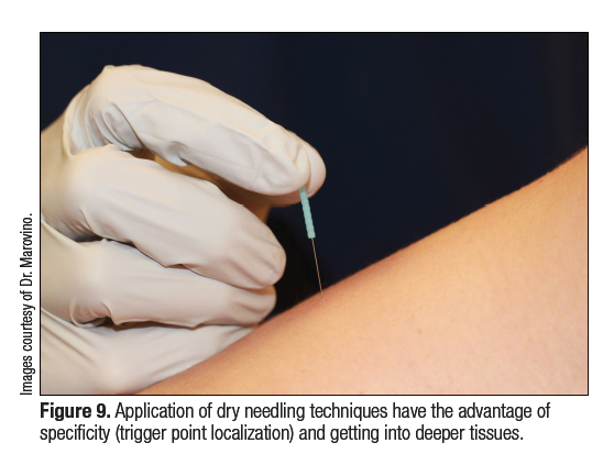 Extracorporeal Shock Wave Therapy—Application for Trigger Points