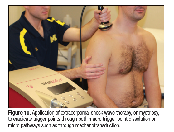 Extracorporeal Shock Wave Therapy—Application for Trigger Points