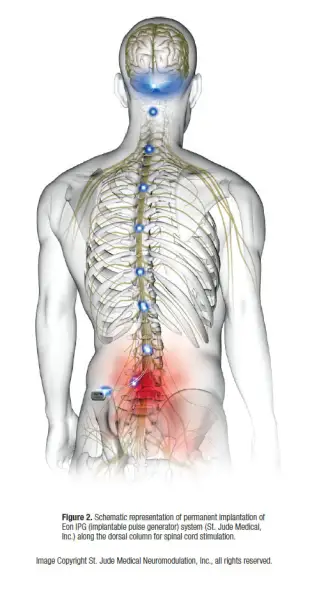 Spinal Cord Stimulator for Pain Relief - Neuroaxis