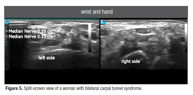 Diagnostic Ultrasound in Carpal Tunnel Syndrome: A Helpful Additional Tool