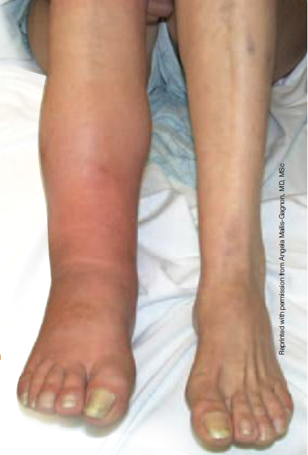 Crps: Current Diagnosis And Therapy (PROGRESS IN PAIN RESEARCH AND MANAGEMENT) Wilson， Peter R.、 Stanton-Hicks， Michael; Harden， R. Norman CRPS: Current Diagnosis And Therapy (Progress in Pain