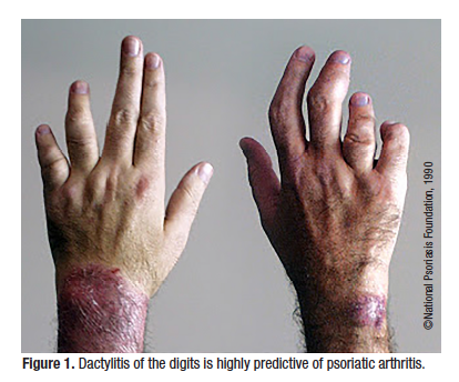 Psoriatic Arthritis Current Strategies For Diagnosis and Treatment