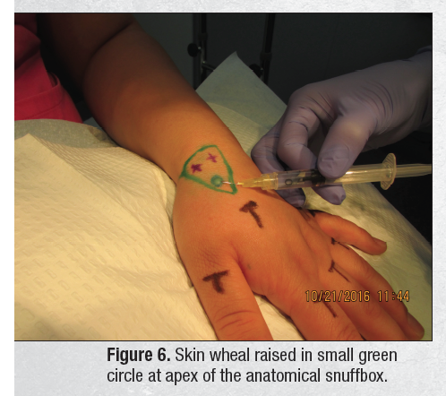 Step-by-Step Technique for Targeting Superficial Radial Nerve Pain