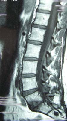 Low Back Pain Two Years Post Recurrent Disc Excision