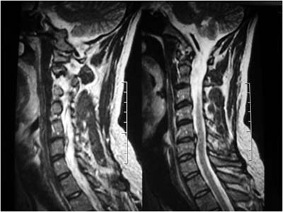 Cervical Radiculopathy: Classic Case?