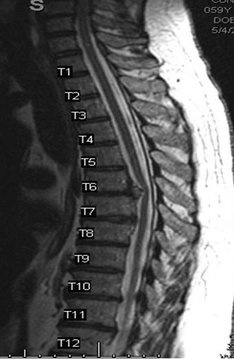 Severe Thoracic Pain Leads to Spinal Fusion
