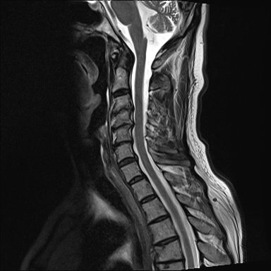 Multi-level Cervical Fusion with Significant Risk of Pseudarthrosis