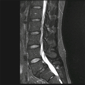 L5-S1 Spondylolisthesis in a Young Female, Previous Gymnast