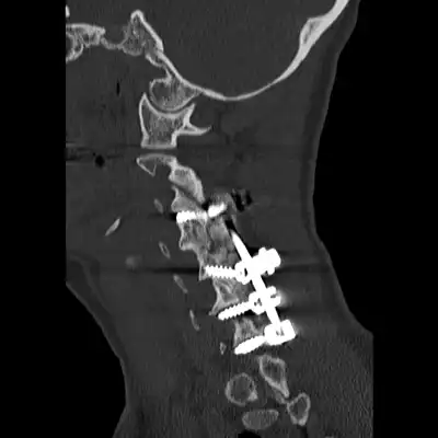 Lateral cervical spine showing C0-C3 fusion in reduced position