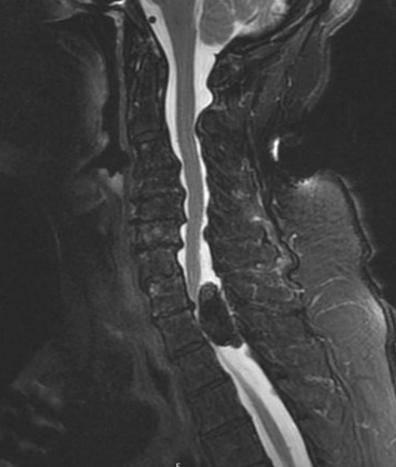 Intradural Calcified Thoracic Meningioma