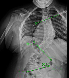 Double Major Curve in an Adolescent