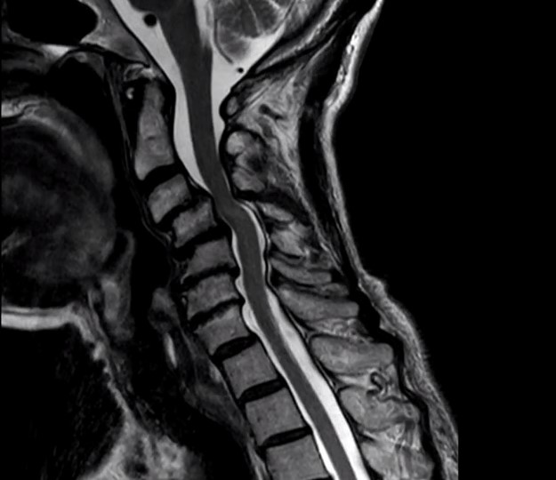 Cervical Deformity and Myelopathy in an Elderly Female