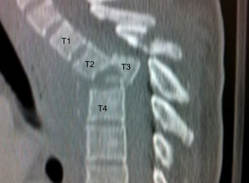 Traumatic T3 Burst Fracture