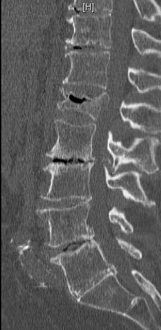 Acute osteoporotic compression fracture - L5