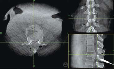 T12-L3 Fixation across L2: Burst Fracture