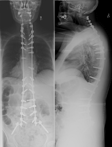 glp 1 ankylosing spondylitis Stories like this are why so many people are asking about GLP-1 medications. In our latest episode of the Live Yes! With Arthritis Podcast, we explore what these medications are, how they Glucagon-Like Peptide-1 (GLP-1) receptor agonists