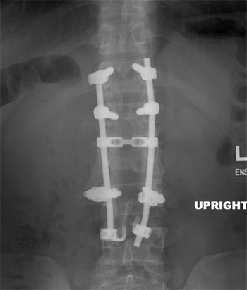 T12-L3 Fixation across L2: Burst Fracture