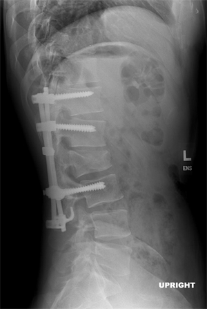 T12-L3 Fixation across L2: Burst Fracture