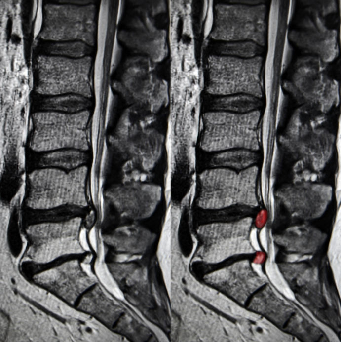 MRI Not Helpful Herniated Disc-Related Sciatica Treatment