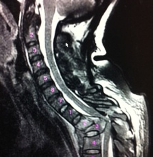 Traumatic T3 Burst Fracture