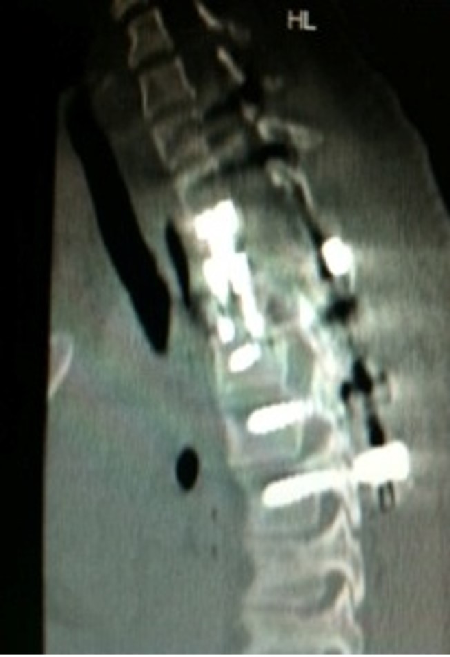 Traumatic T3 Burst Fracture