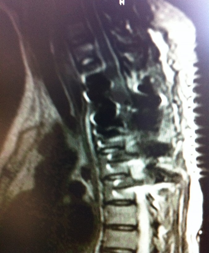 Traumatic T3 Burst Fracture