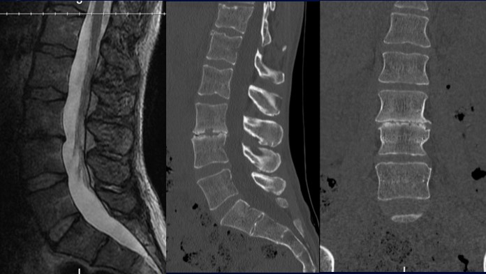 L3-L4 Treatment